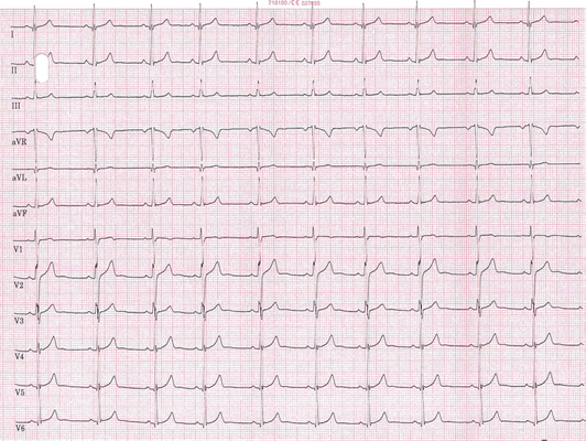12-Kanal EKG